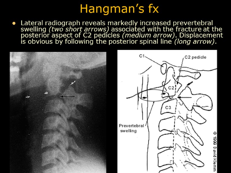 Hangman’s fx Lateral radiograph reveals markedly increased prevertebral swelling (two short arrows) associated with